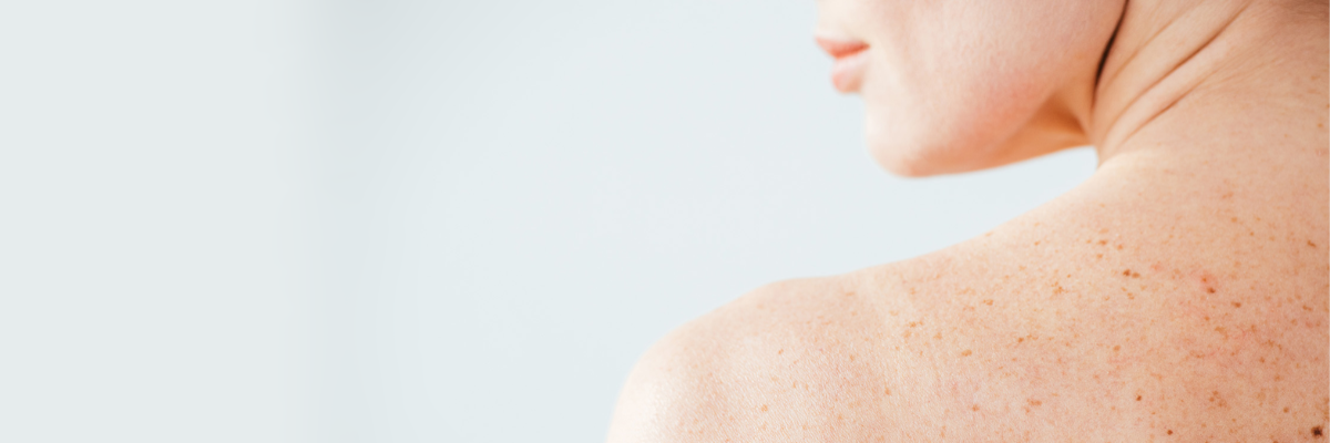 Μελάνωμα: Μπορεί να Προληφθεί – Τι Πρέπει να Γνωρίζουμε