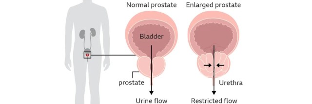 What happens if the prostate is removed?